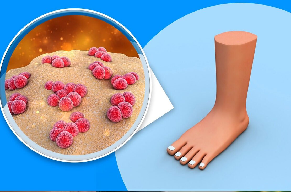 Ausbruch der Maul- und Klauenseuche in Deutschland