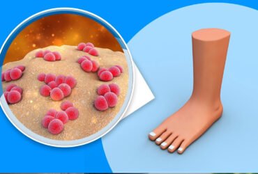 Ausbruch der Maul- und Klauenseuche in Deutschland